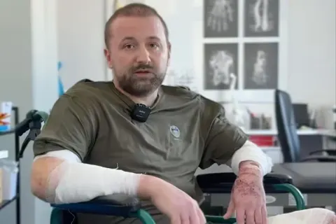 У Львові врятували чоловіка з 80% опіків: як шкіра риби та свині допомагає у лік